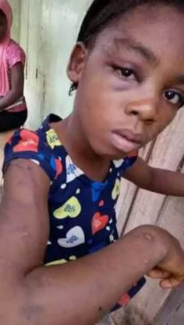 Little Girl Brutally Beaten By Her Heartless Father In Ibadan [Photos]